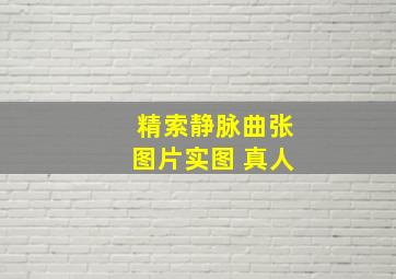 精索静脉曲张图片实图 真人